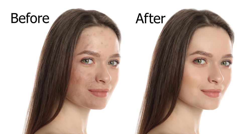 chemical skin peel before and after