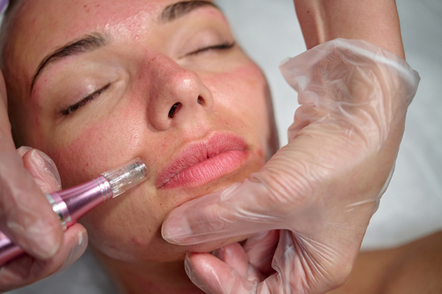 RyanRae-microneedling-skin-rejuvenation