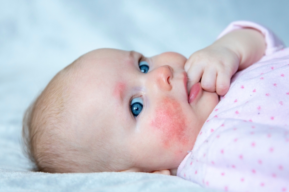 ryanrae-skin-baby-rash-pediatric-allergies