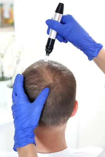 Hair Loss Treatment