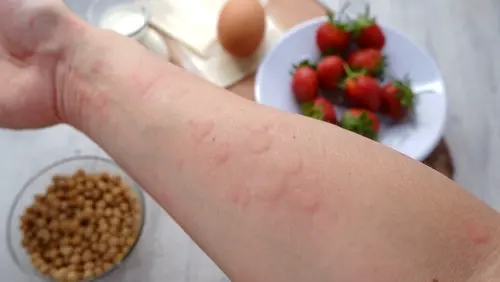 Skin Rash and Food Allergy