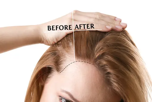 Hair Loss Treatment