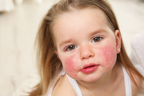 Comprehensive Allergy Evaluation - determining what kind of allergies kids have